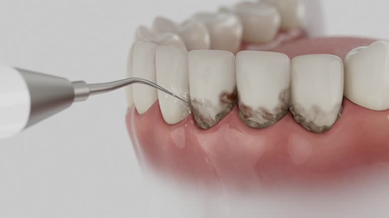 Trusted Teeth Cleaning And Checkup service in Notre Dame, IN - Dentist Open Now